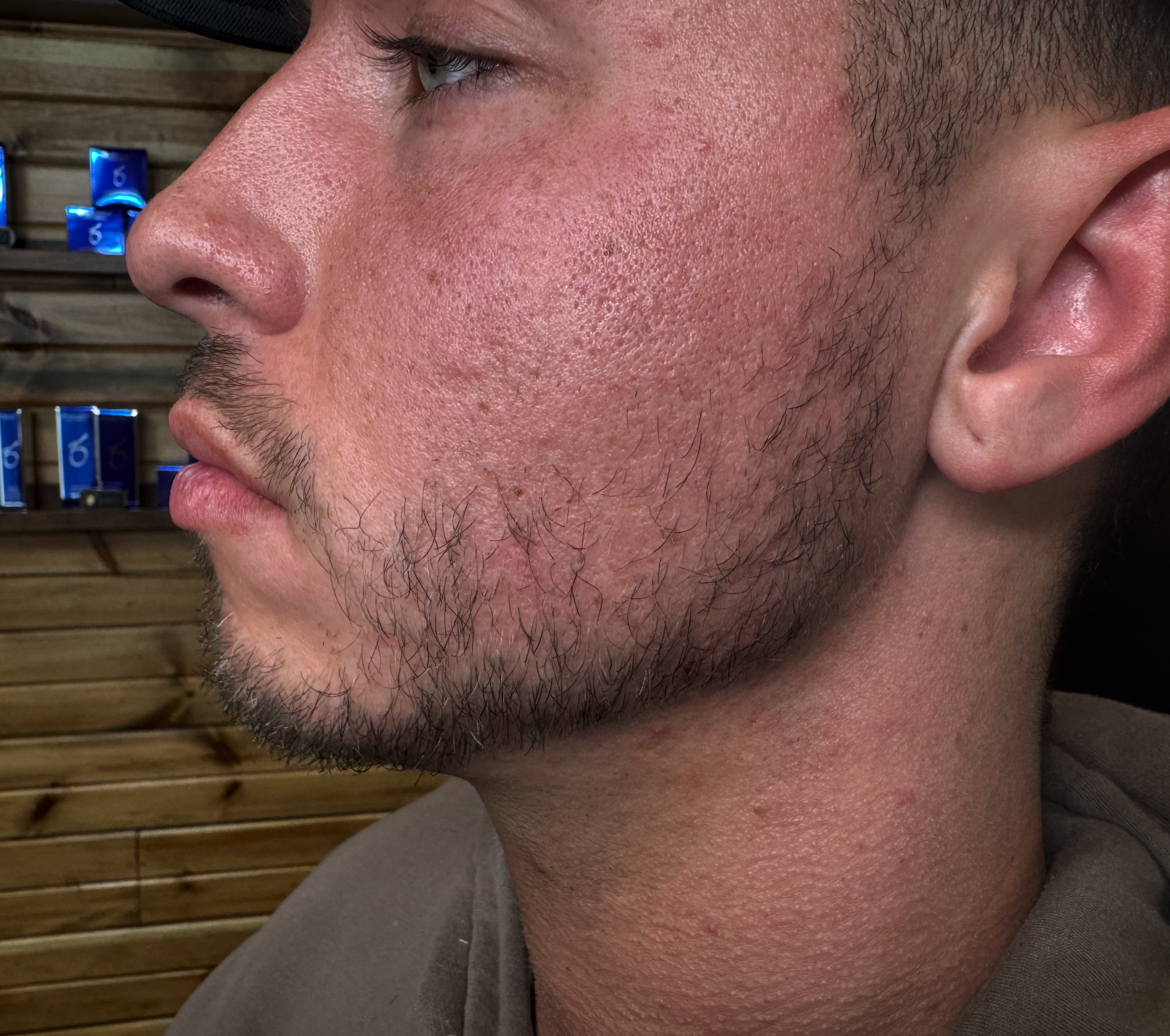 Dermal Filler at D'Vinely You Aesthetics