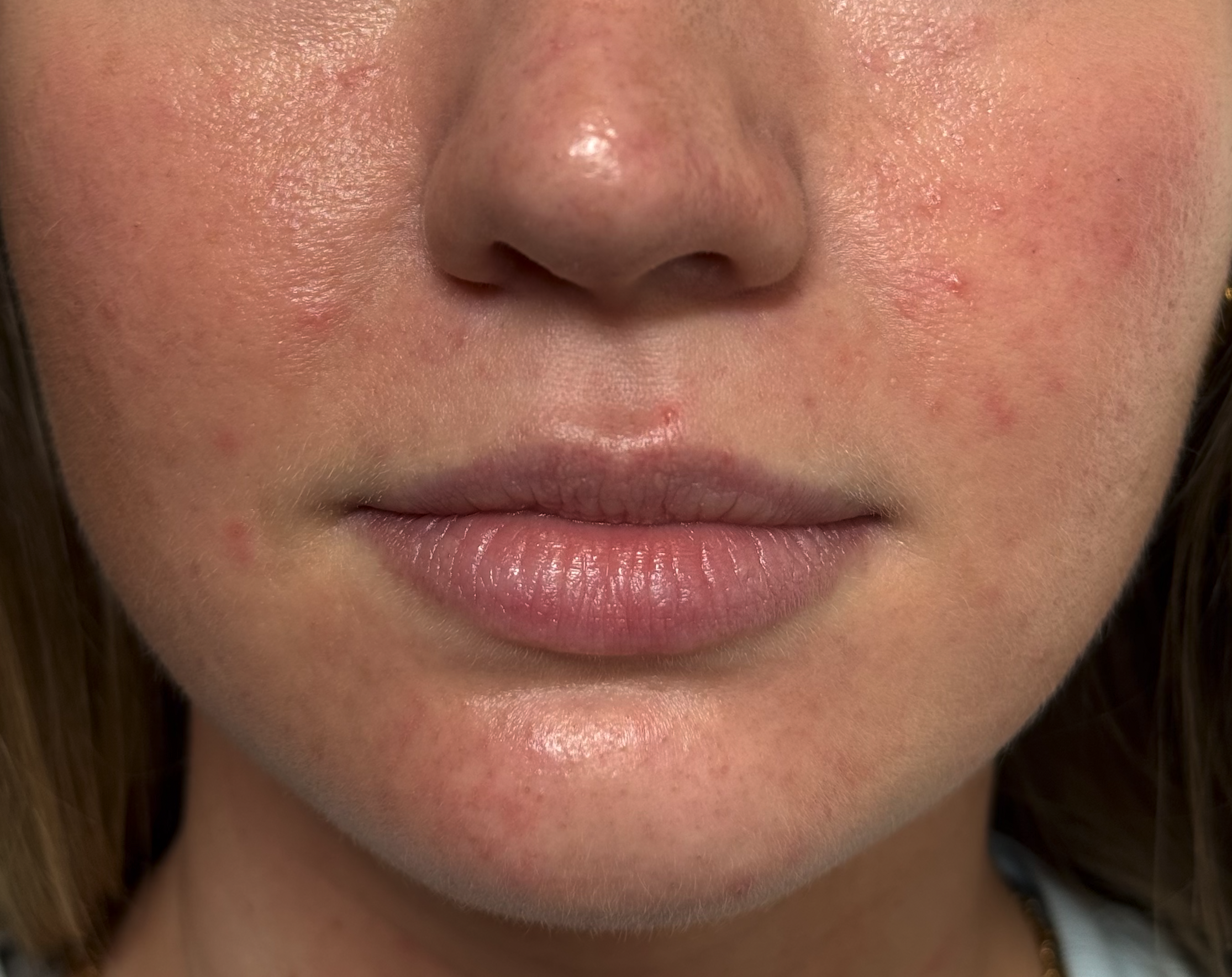 Before Lip Filler at D'Vinely You Aesthetics
