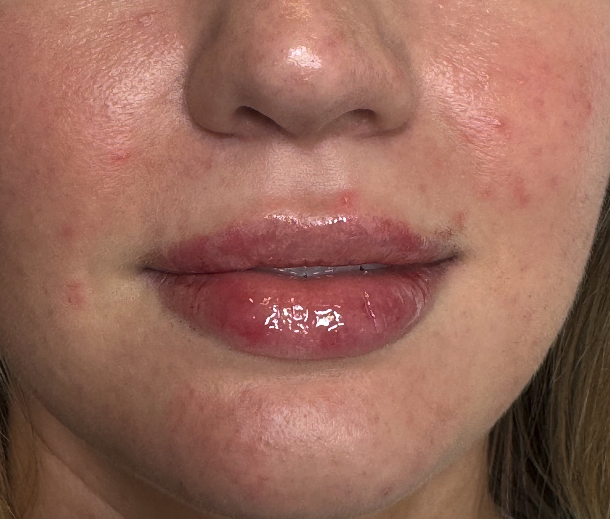 After Lip Filler at D'Vinely You Aesthetics