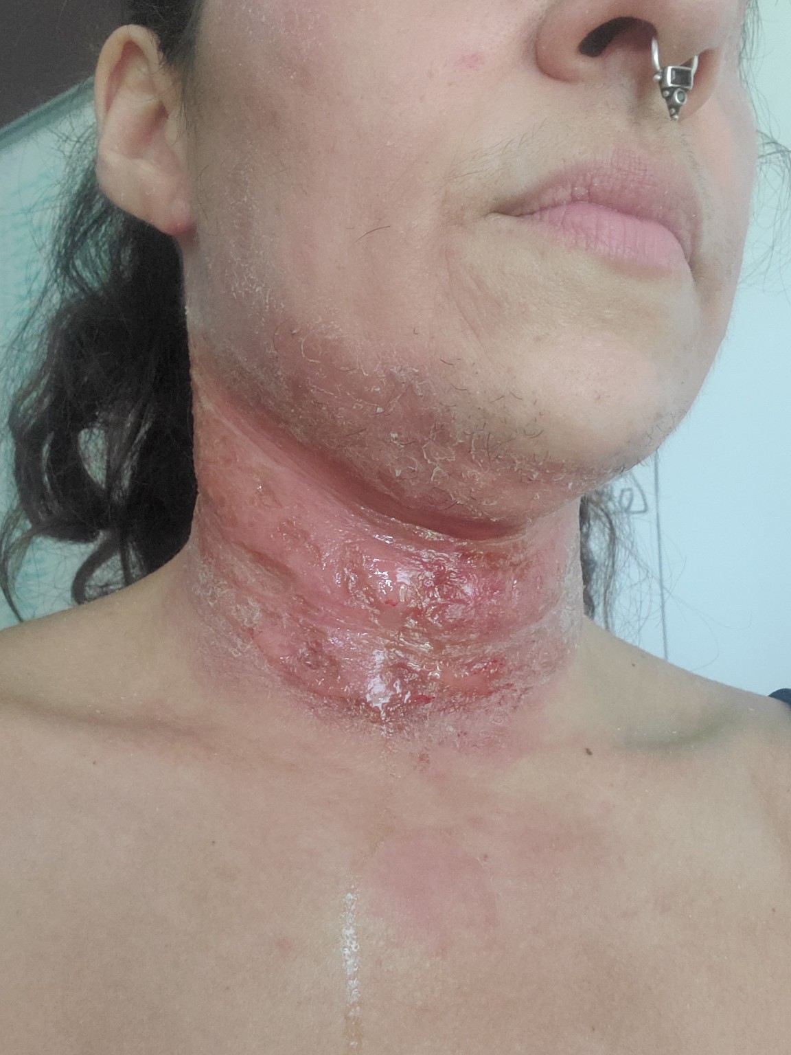 Close-up documenting the irritated, oozing skin on Melodie's neck in August 2024