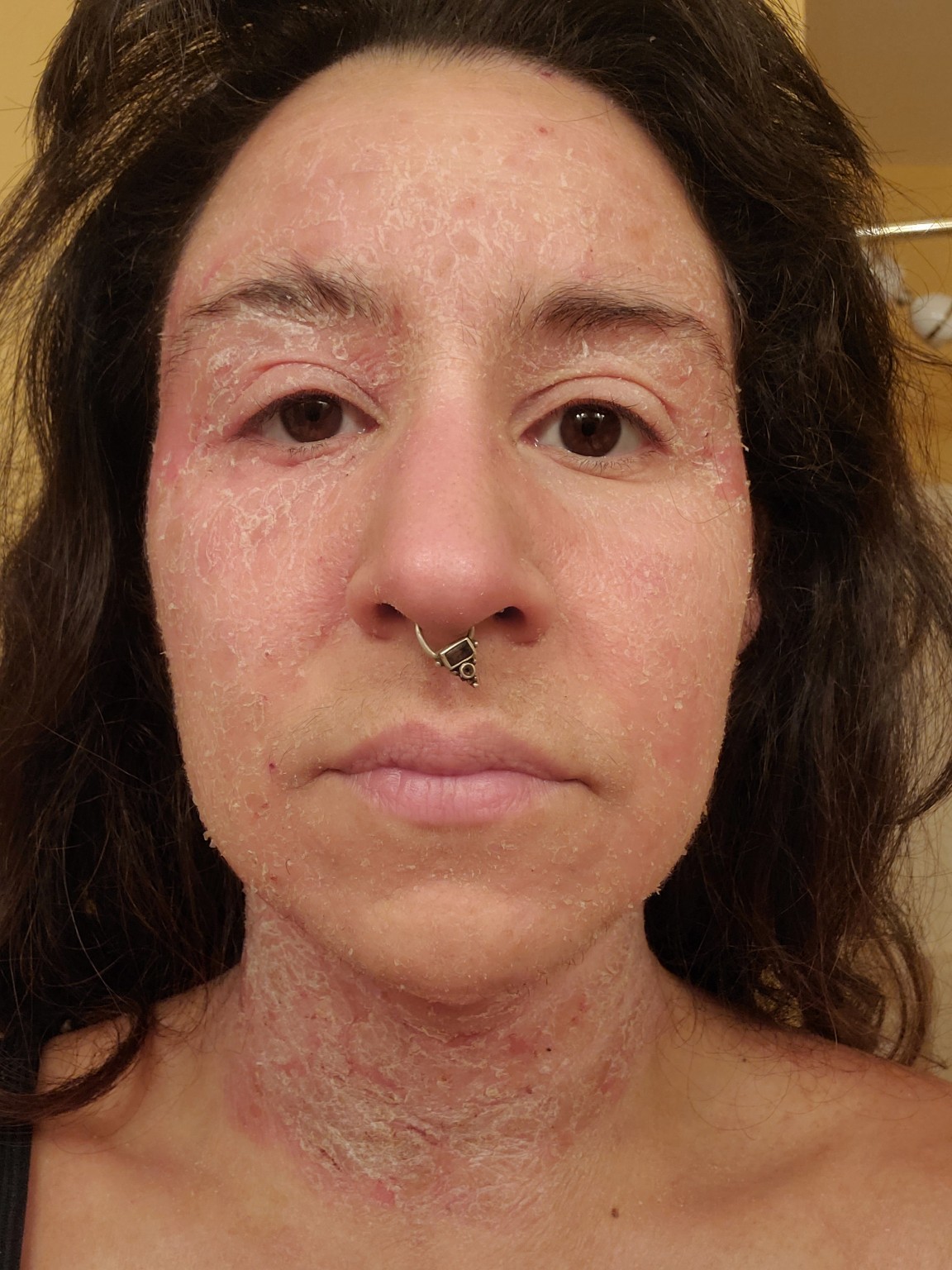 Melodie during her skin struggles in August 2024, with visible facial peeling