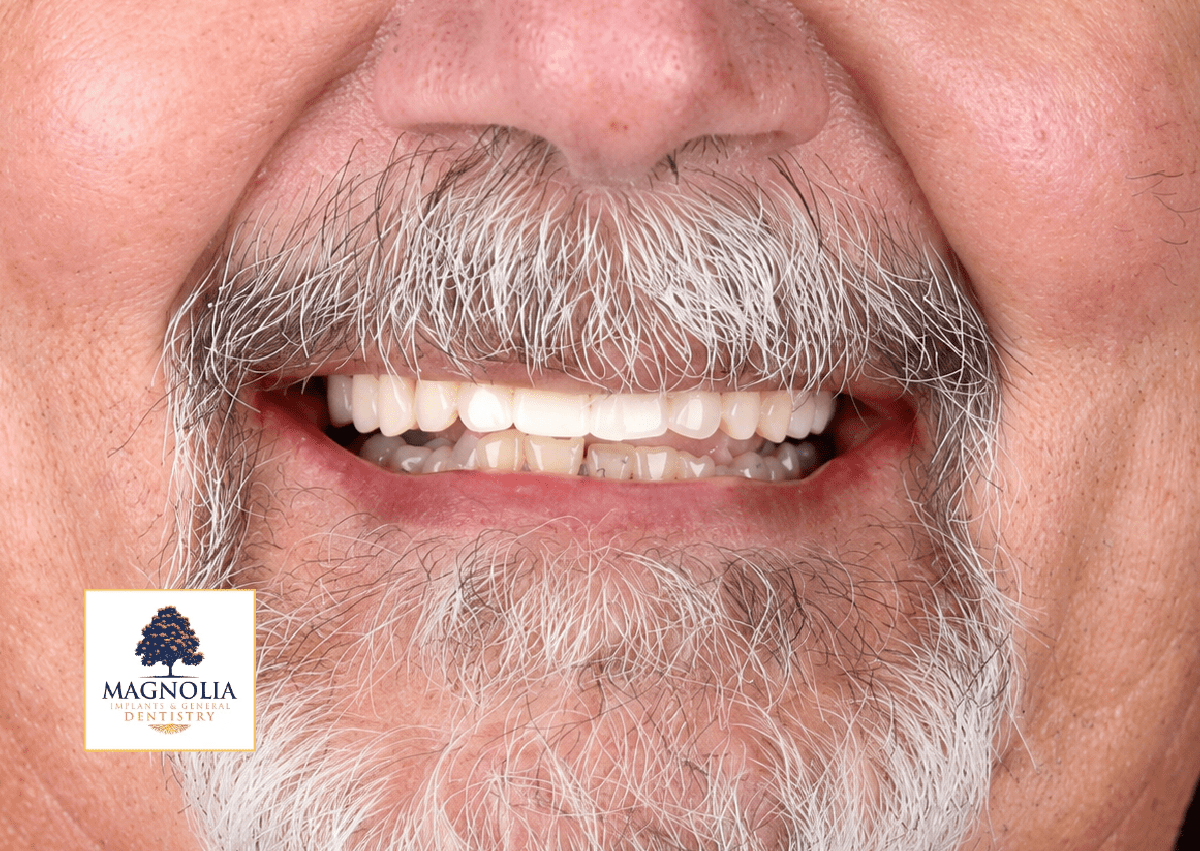 Same patient's smile after dental implant treatment, with an even white smile