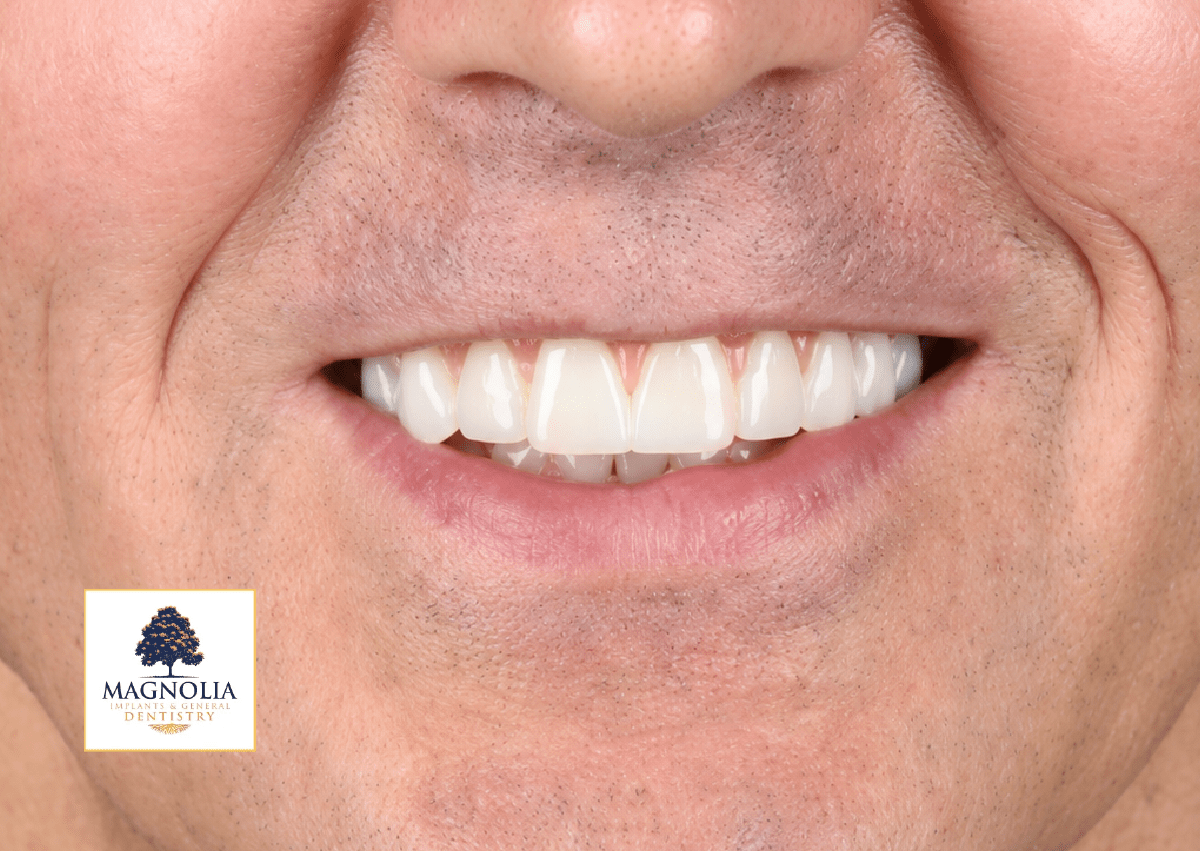 Same patient's smile after dental implant treatment, with straight, white teeth