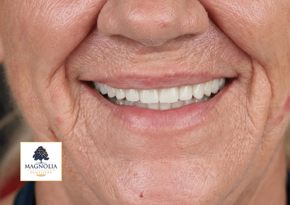 Same patient's smile after dental implant treatment, with a full, even smile