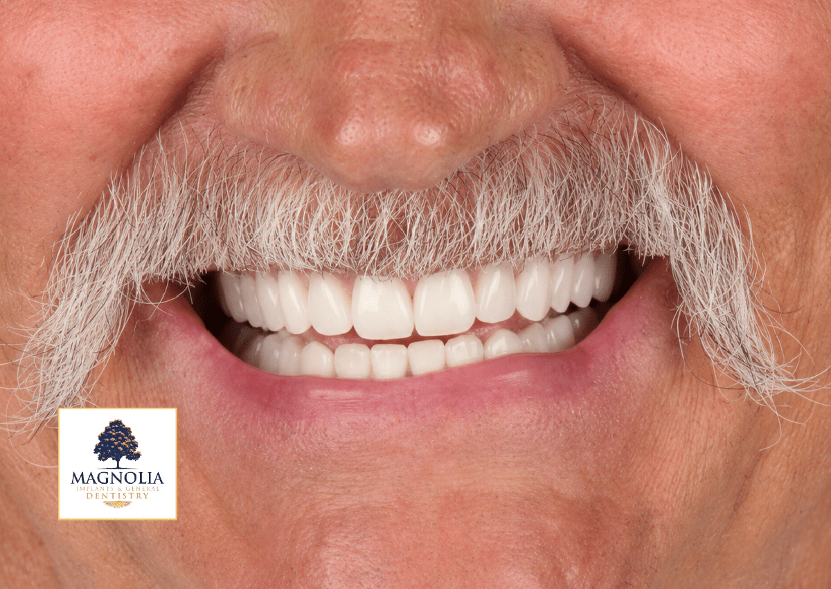 Same patient's smile after dental implant treatment, with a full set of white teeth