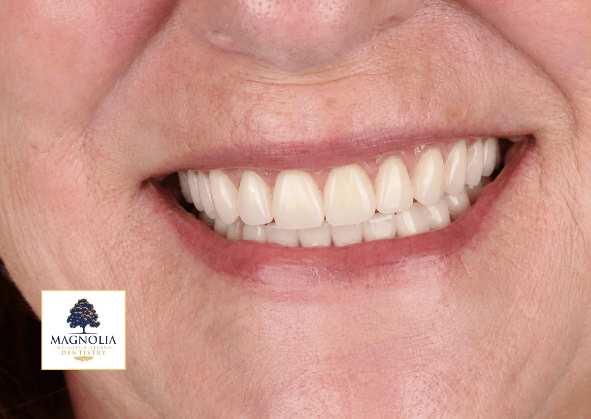 Same patient's smile after dental implant treatment, with an even white smile