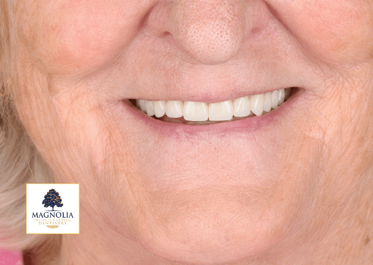 Same patient's smile after dental implant treatment, with a full set of white teeth