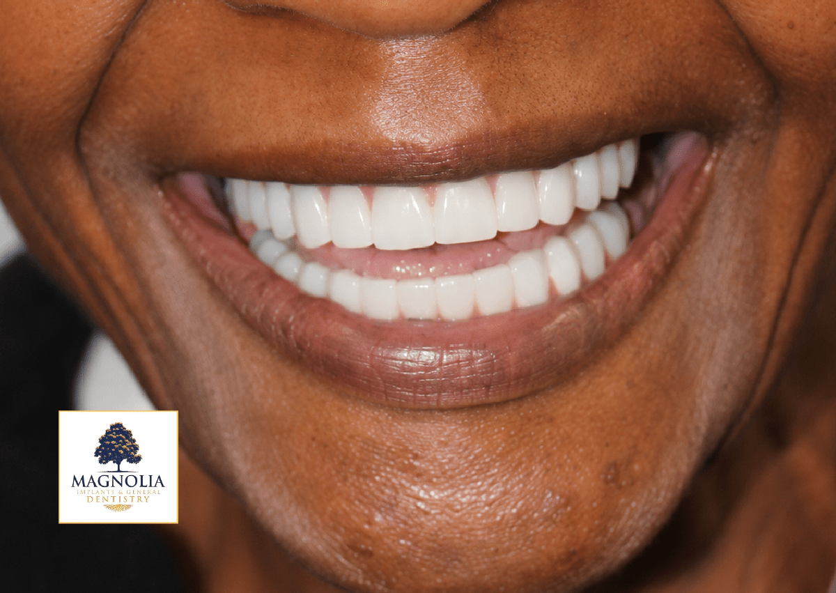 Same patient's smile after dental implant treatment, with a full, bright white smile