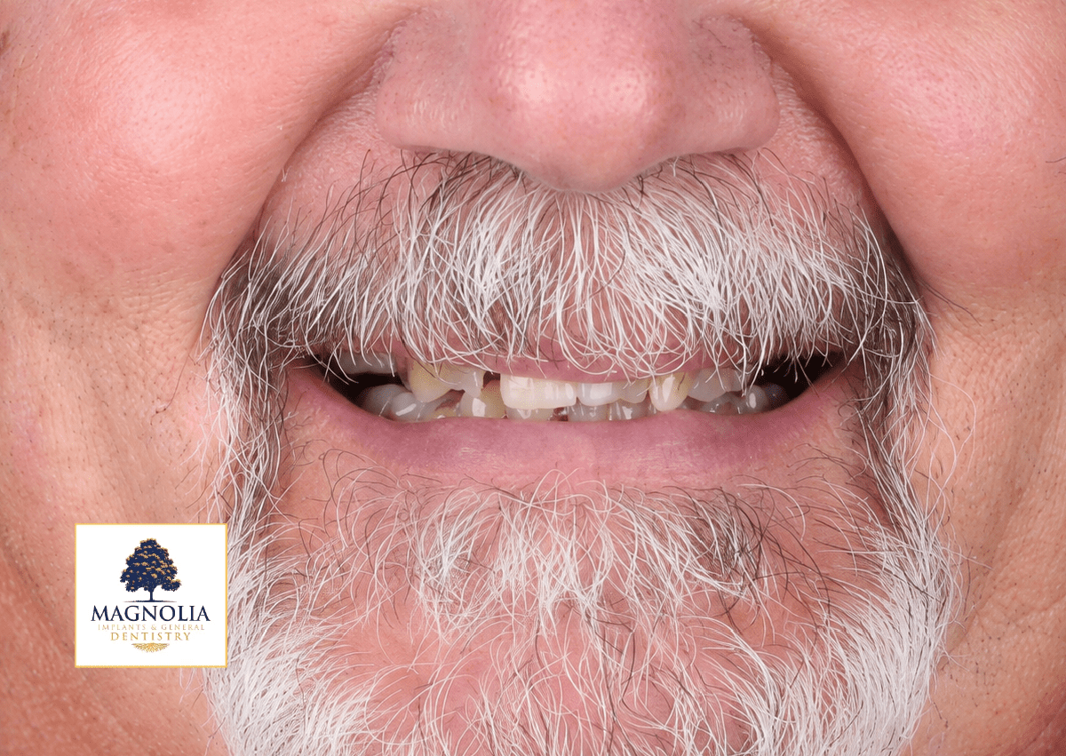 Patient's smile before dental implant treatment, showing discolored and damaged front teeth