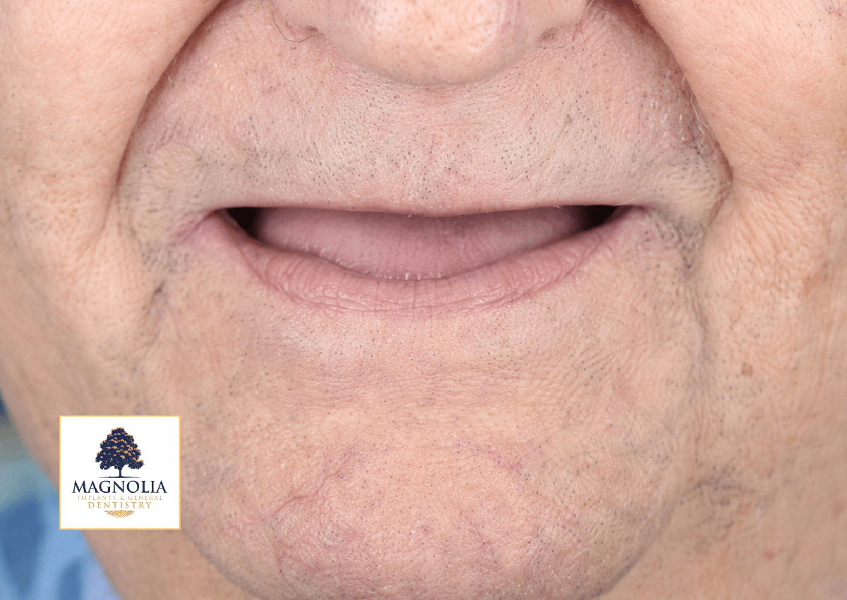 Patient's mouth before dental implant treatment, with no visible teeth