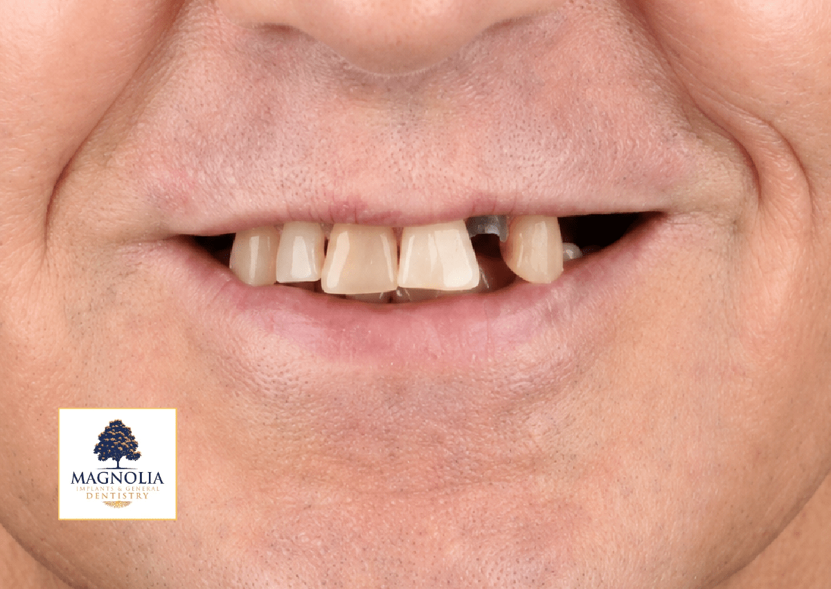 Patient's smile before dental implant treatment, with gapped and missing teeth