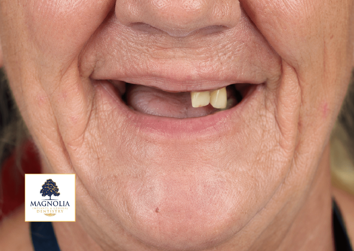 Patient's smile before dental implant treatment, with only a couple of remaining teeth