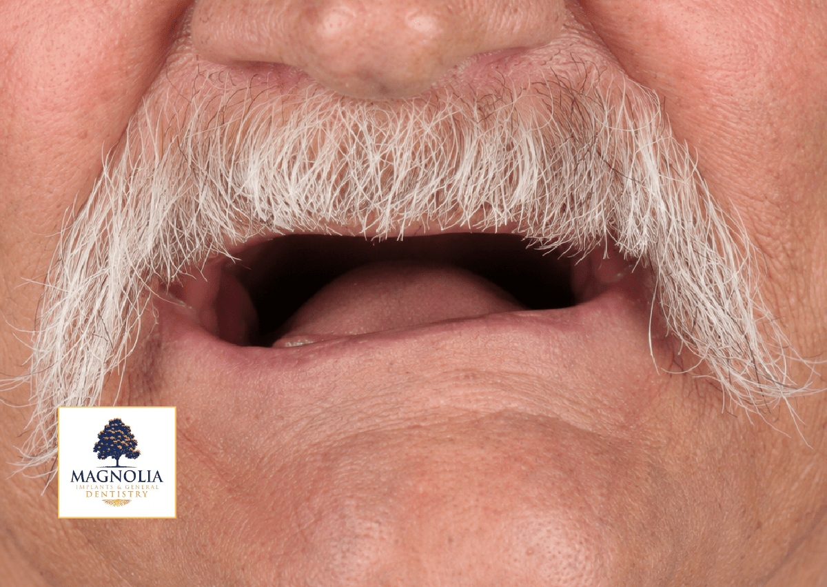 Patient's mouth before dental implant treatment, with no visible teeth