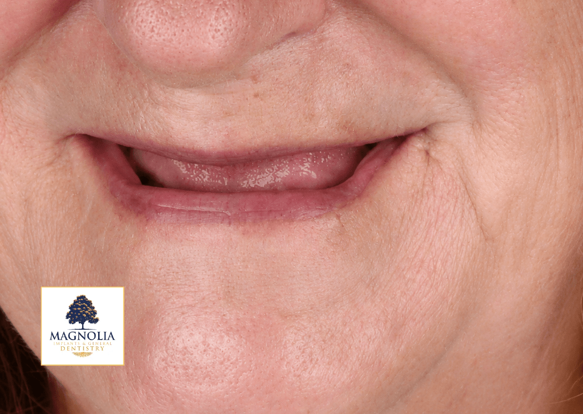 Patient's mouth before dental implant treatment, with no visible teeth