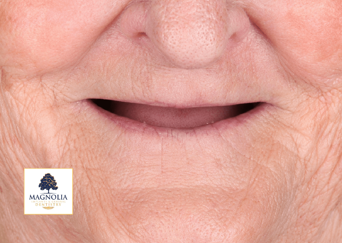 Patient's mouth before dental implant treatment, with no visible teeth