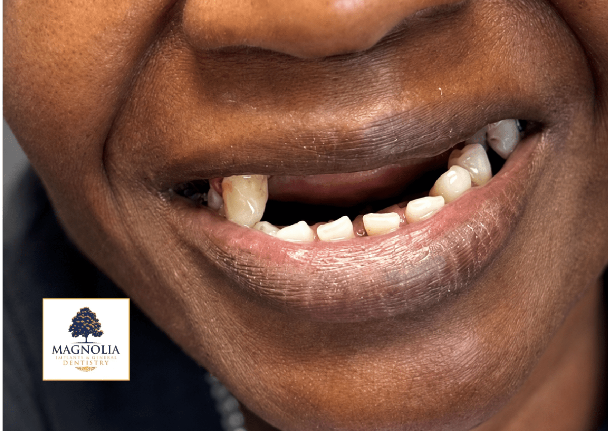 Patient's smile before dental implant treatment, with several missing and damaged teeth