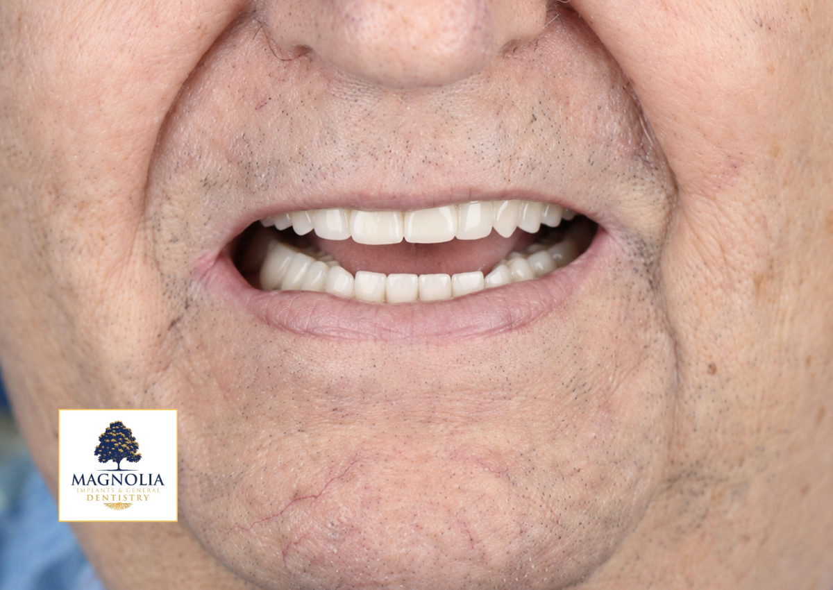 Same patient's smile after dental implant treatment, with a full set of white teeth
