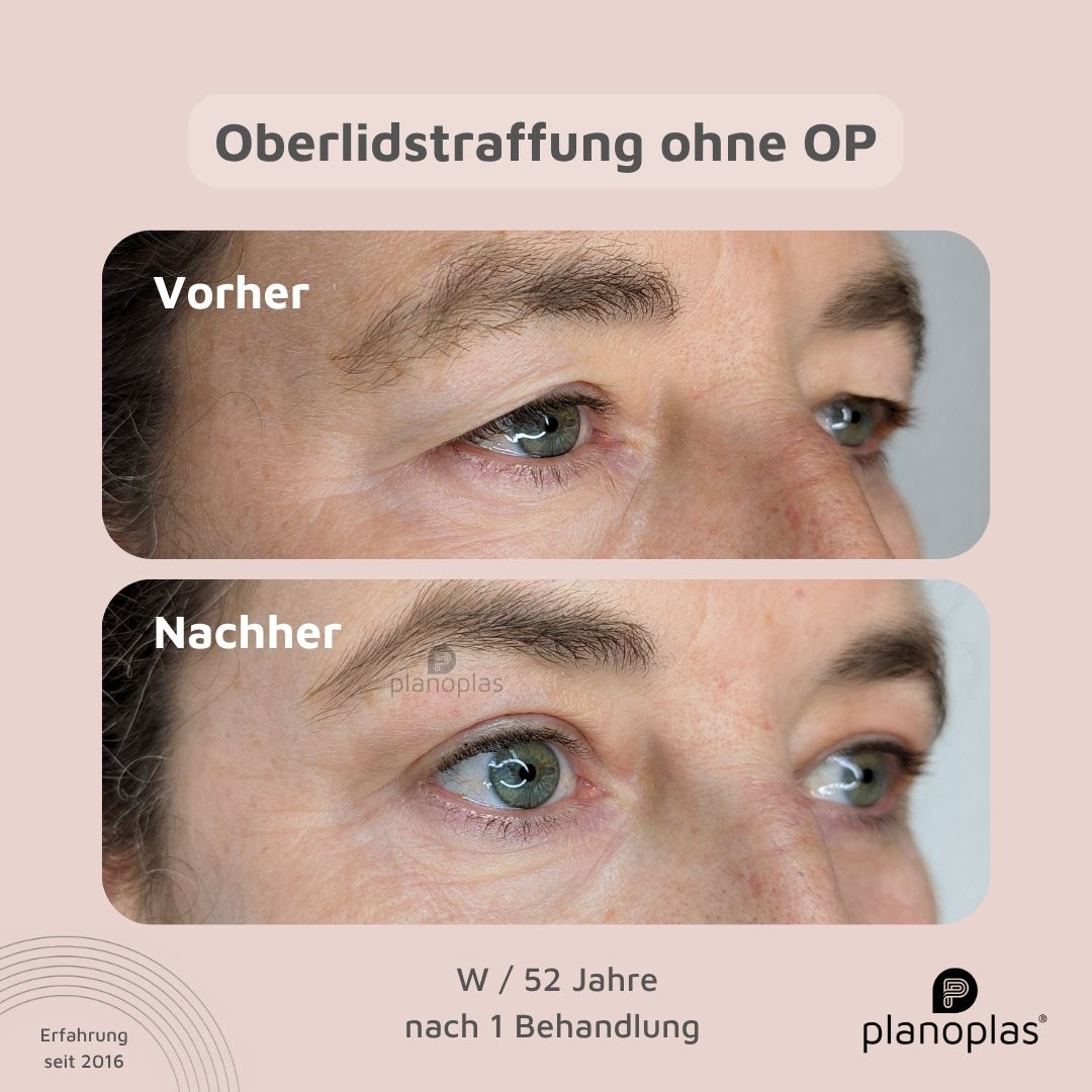 Oberlidstraffung mit Plasma Pen