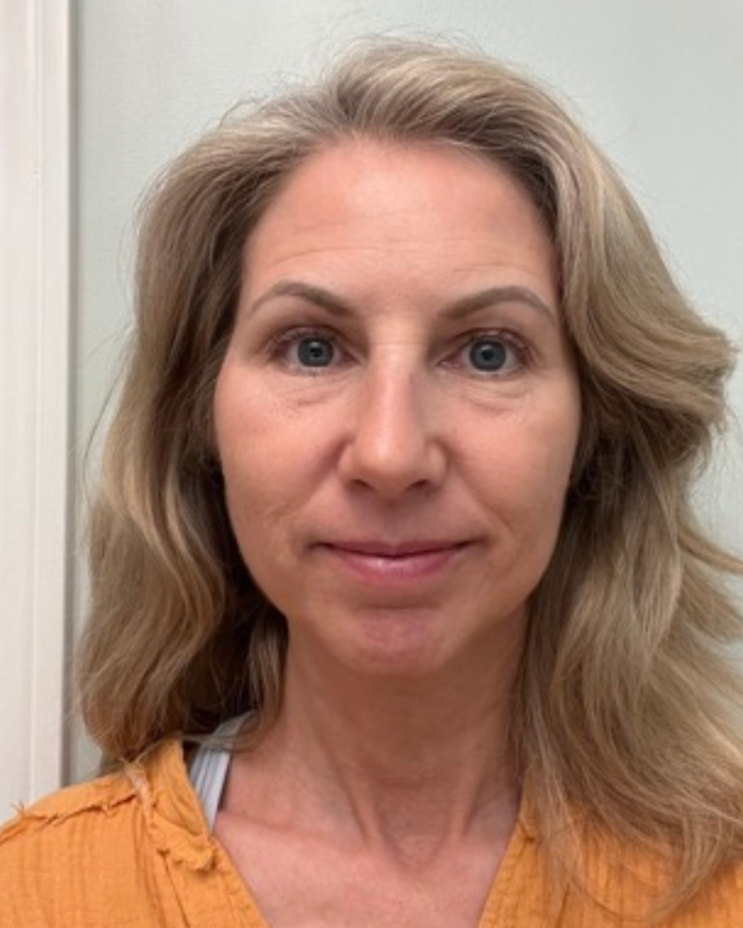 Client 1 before Beauty Longevity treatment