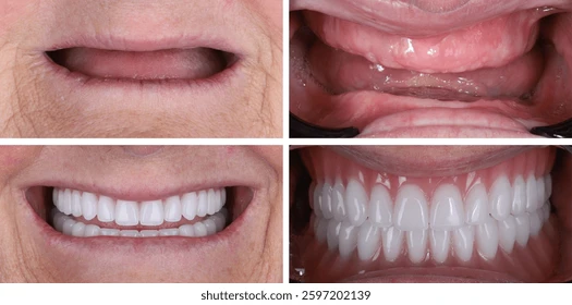 Before and after full-arch implants