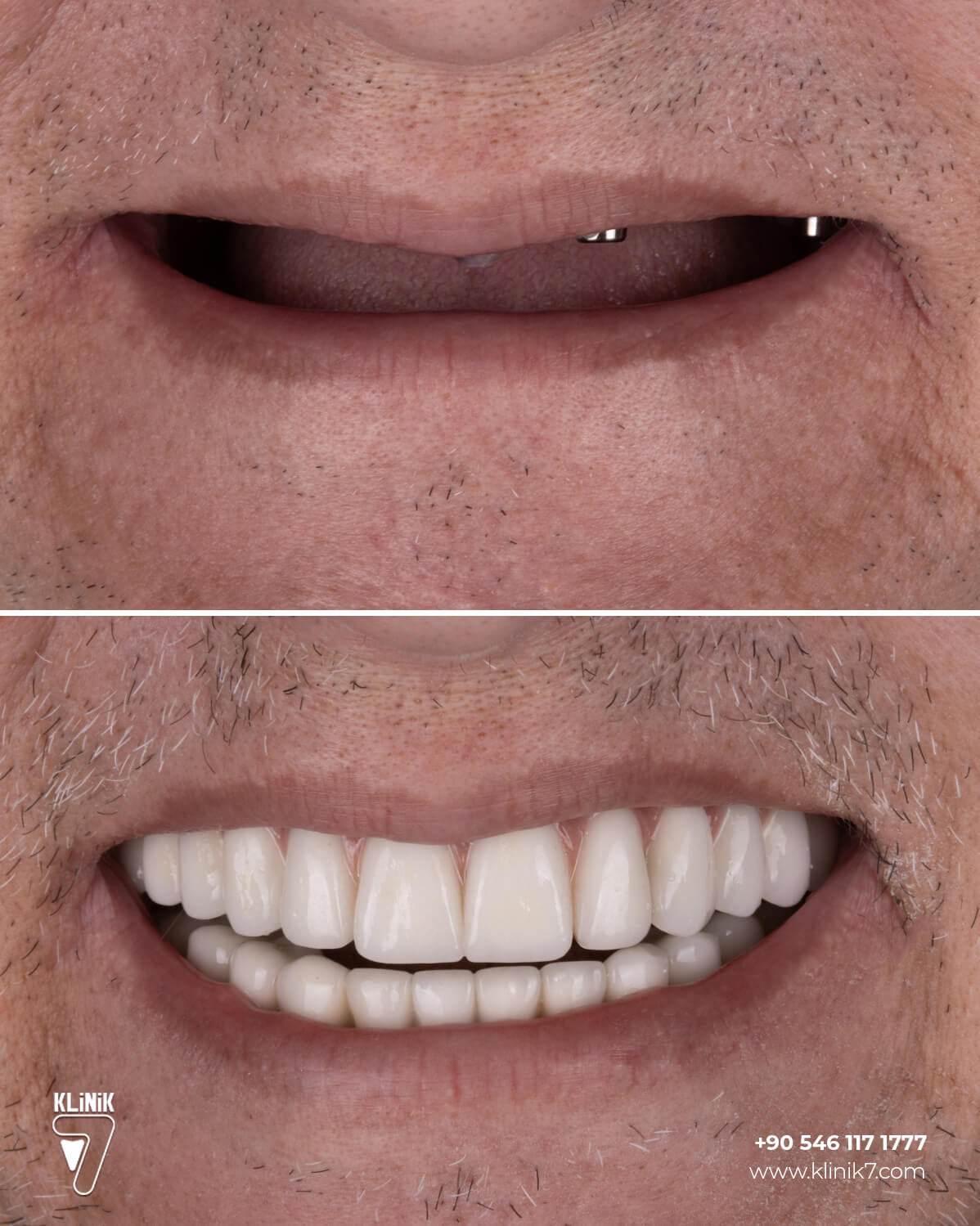 Before and after full-arch implants