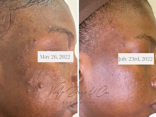 Client skin before and after a chemical peel series