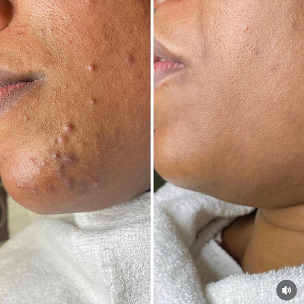 Acne before and after, cheek and jawline