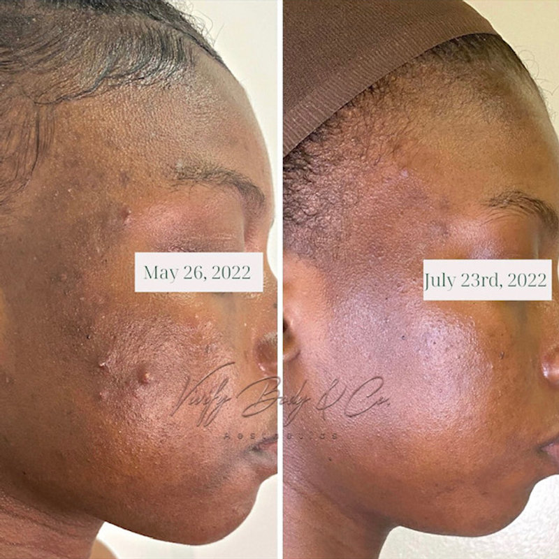 Before and after a chemical peel series on acne-prone skin