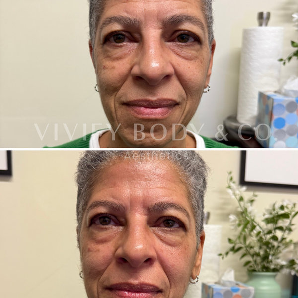 Mature skin before and after