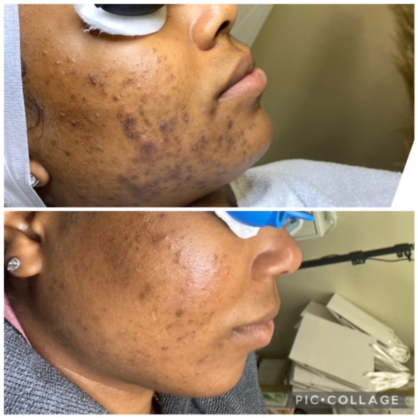 Acne and scarring before and after