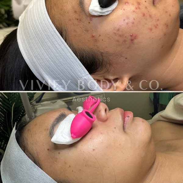 Hyperpigmentation before and after