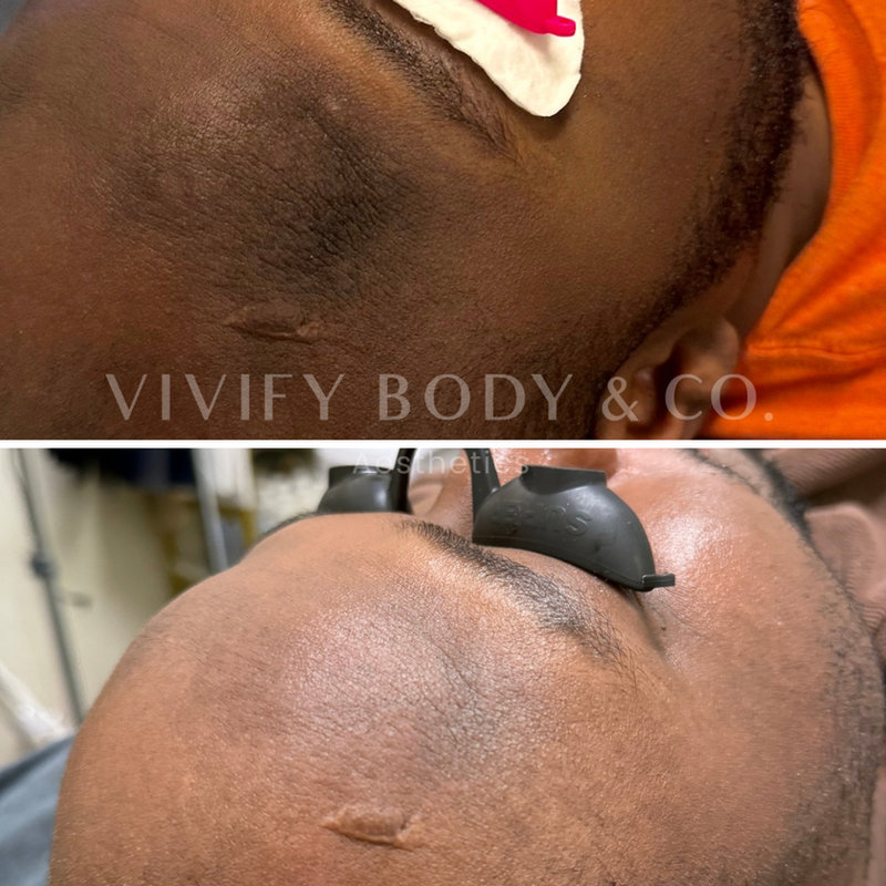 Before and after treatment on deeper skin tone