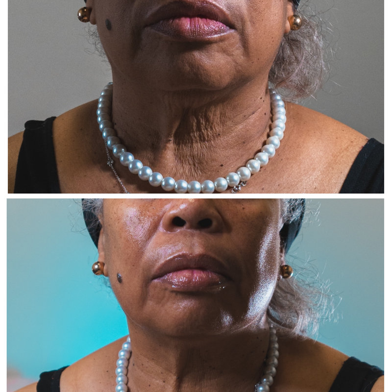 Client skin before and after a Jet Plasma series
