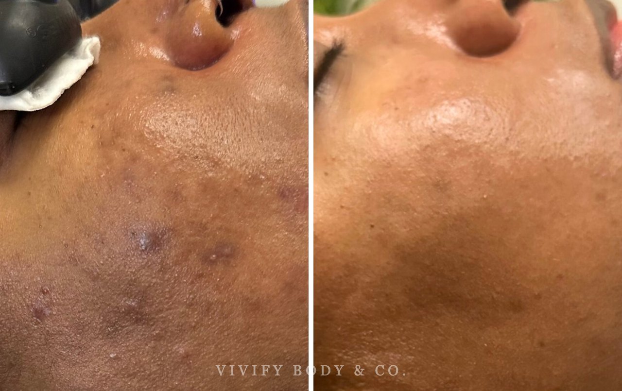 Client skin before and after a chemical peel series