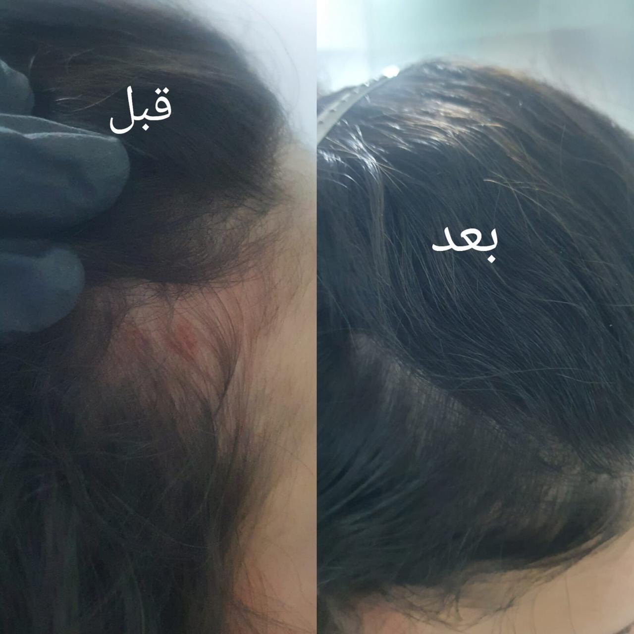 نتيجة حقيقية لحالة شعر وفروة رأس