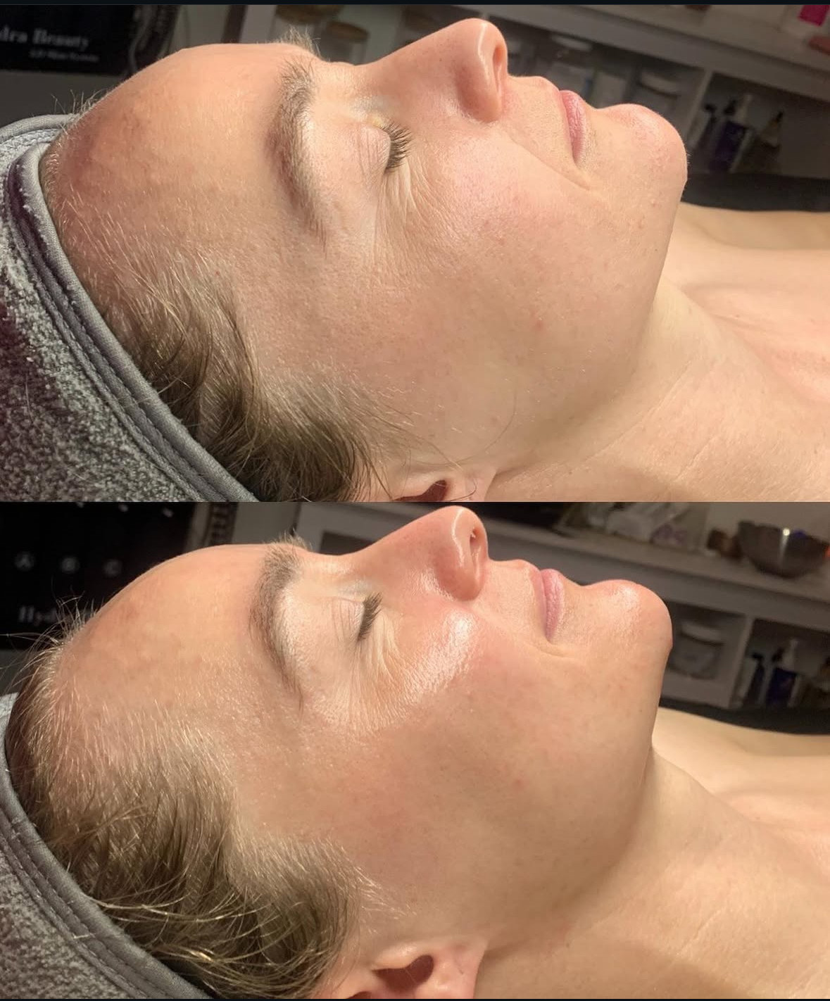 HydraFacial Special