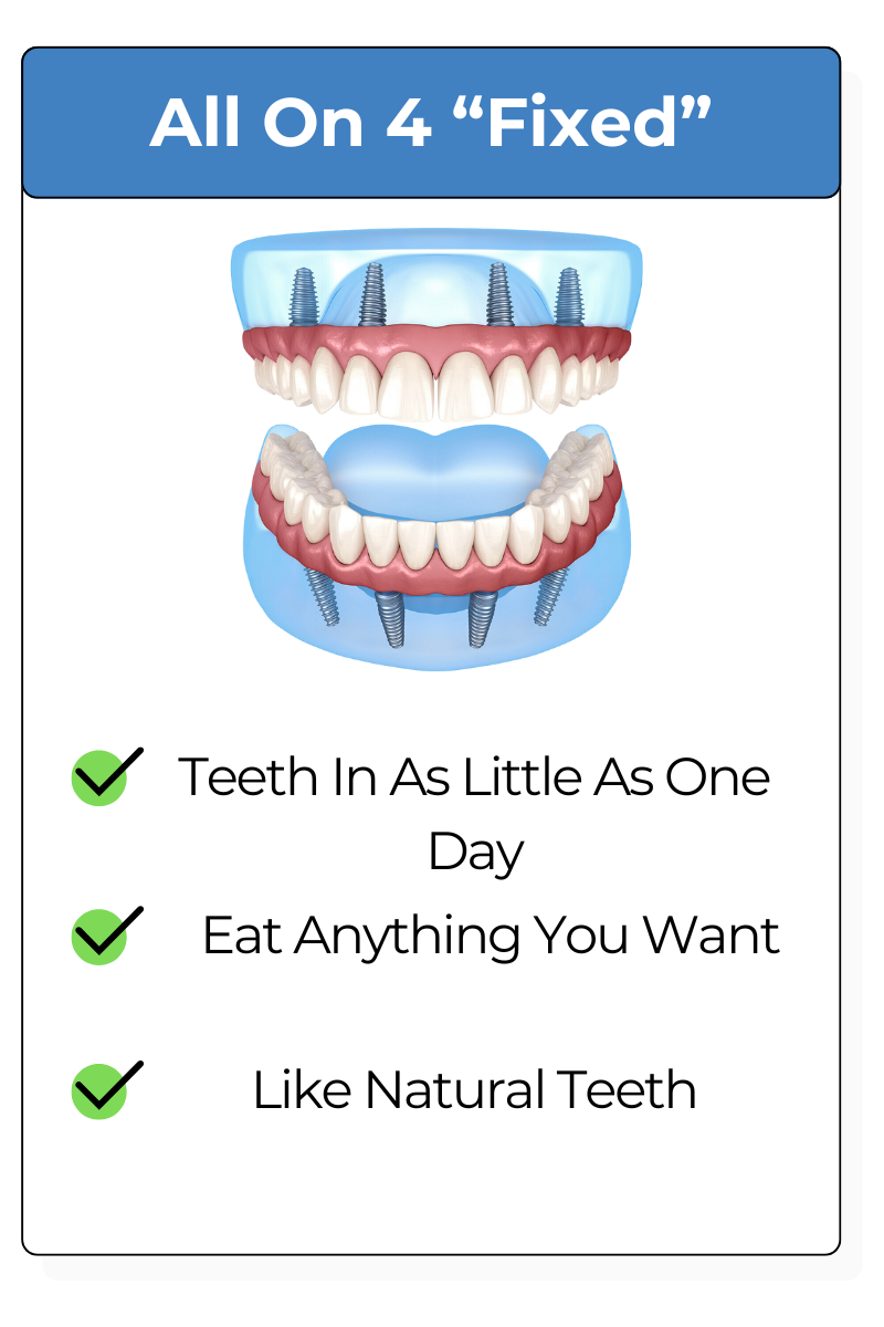 All on Four Dental Implants