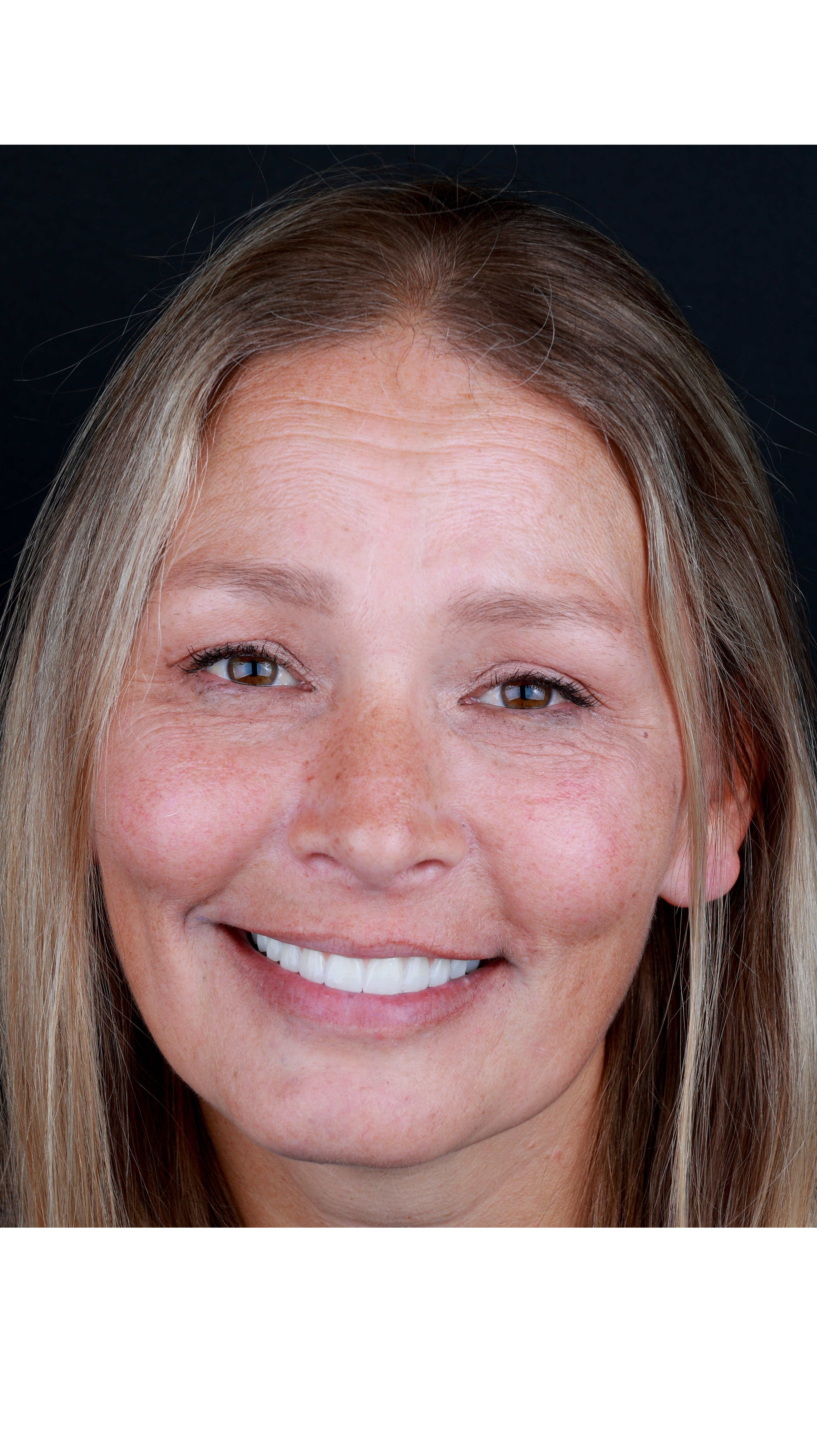 Smiling People Dental Implants