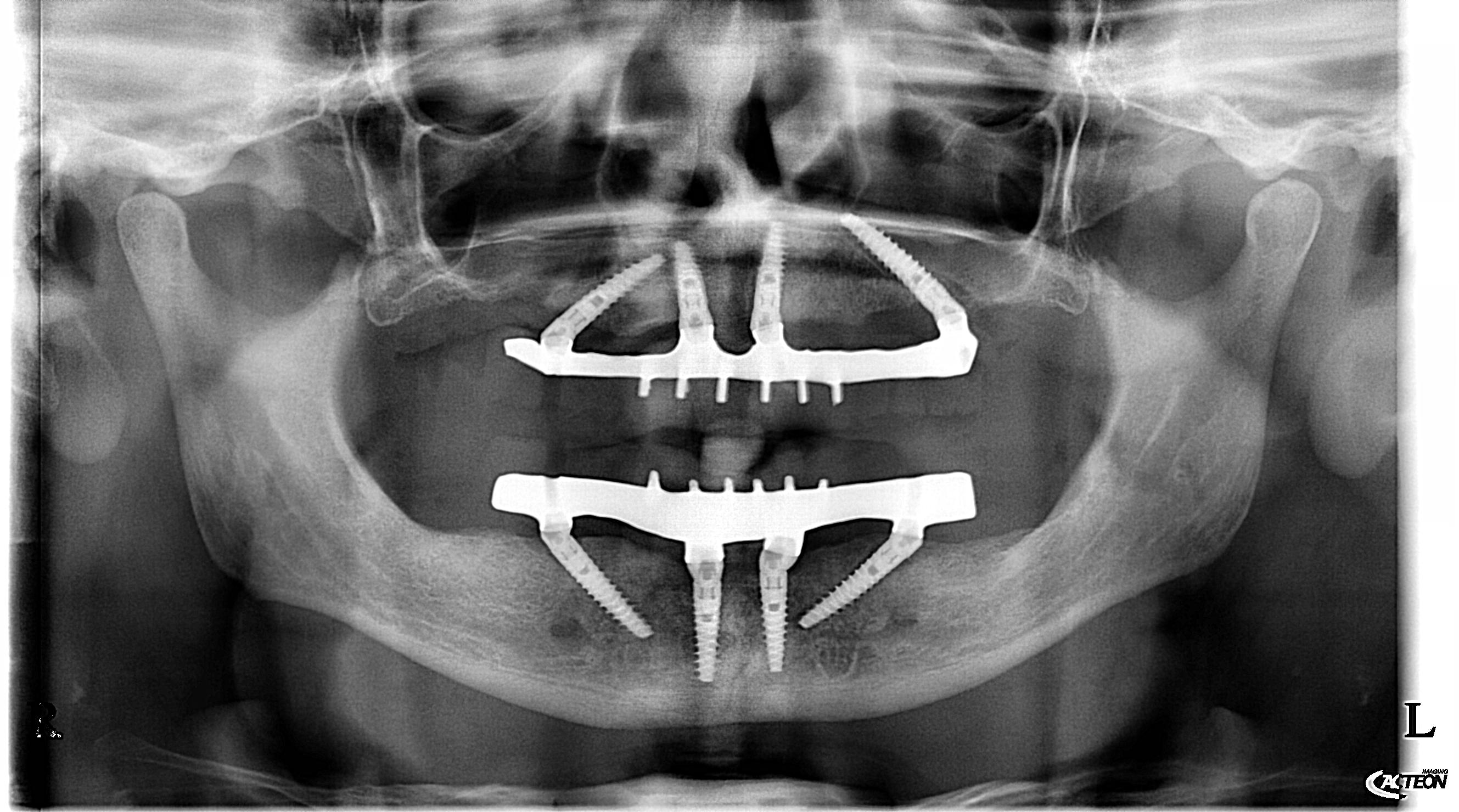 Panoramica dentale dopo la riabilitazione implantare