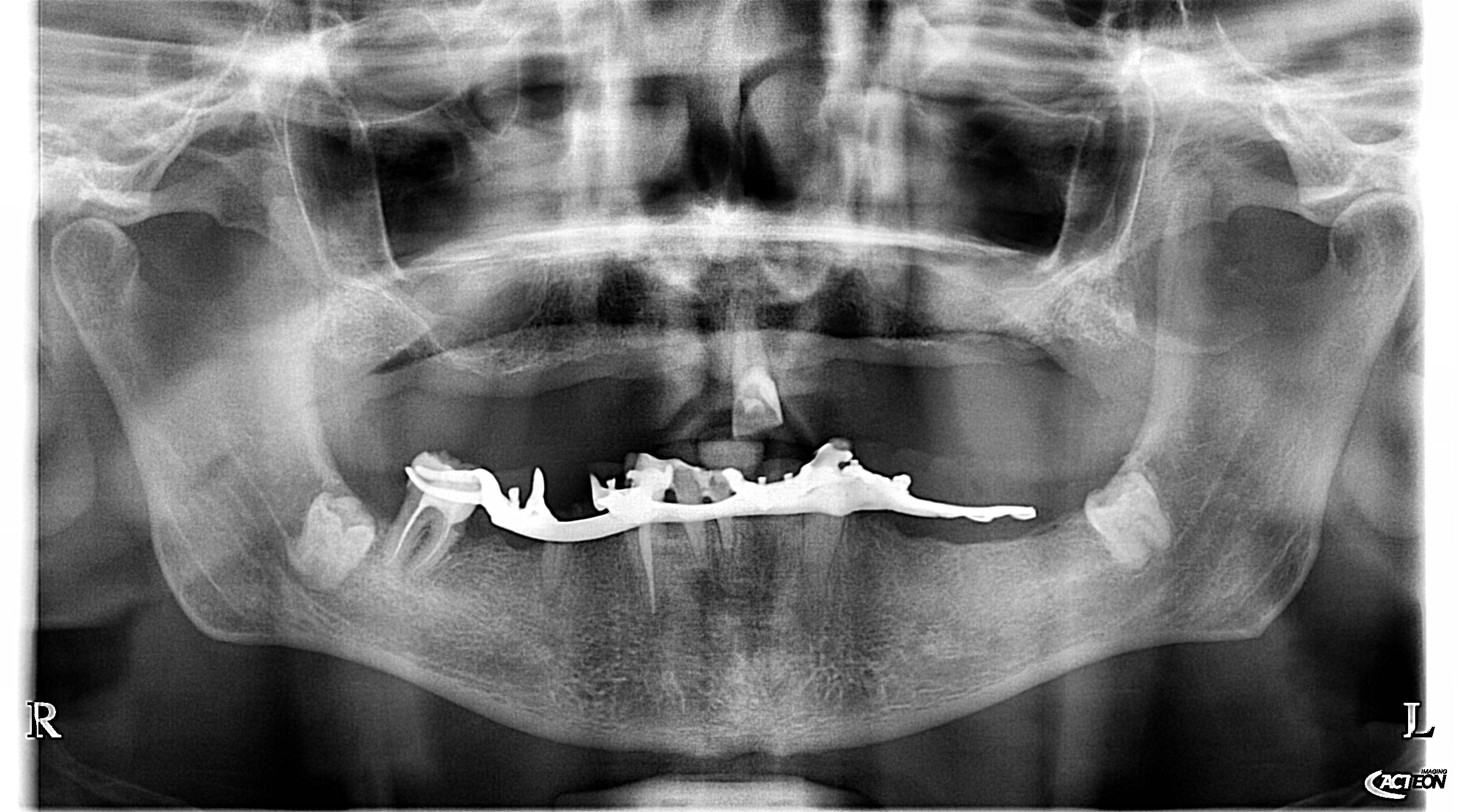 Radiografia panoramica prima — Caso 2