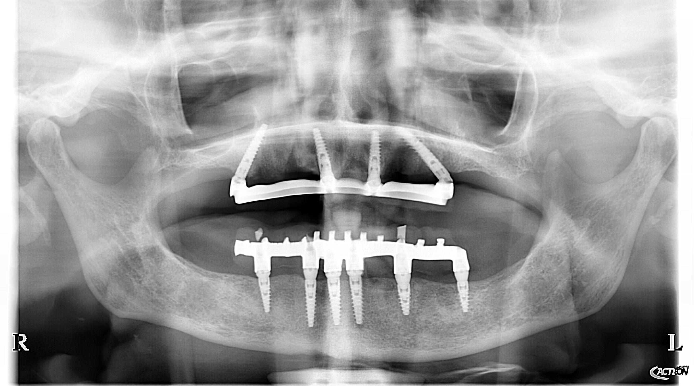 Radiografia panoramica dopo — Caso 4 riabilitazione totale con impianti e protesi fissa a carico immediato