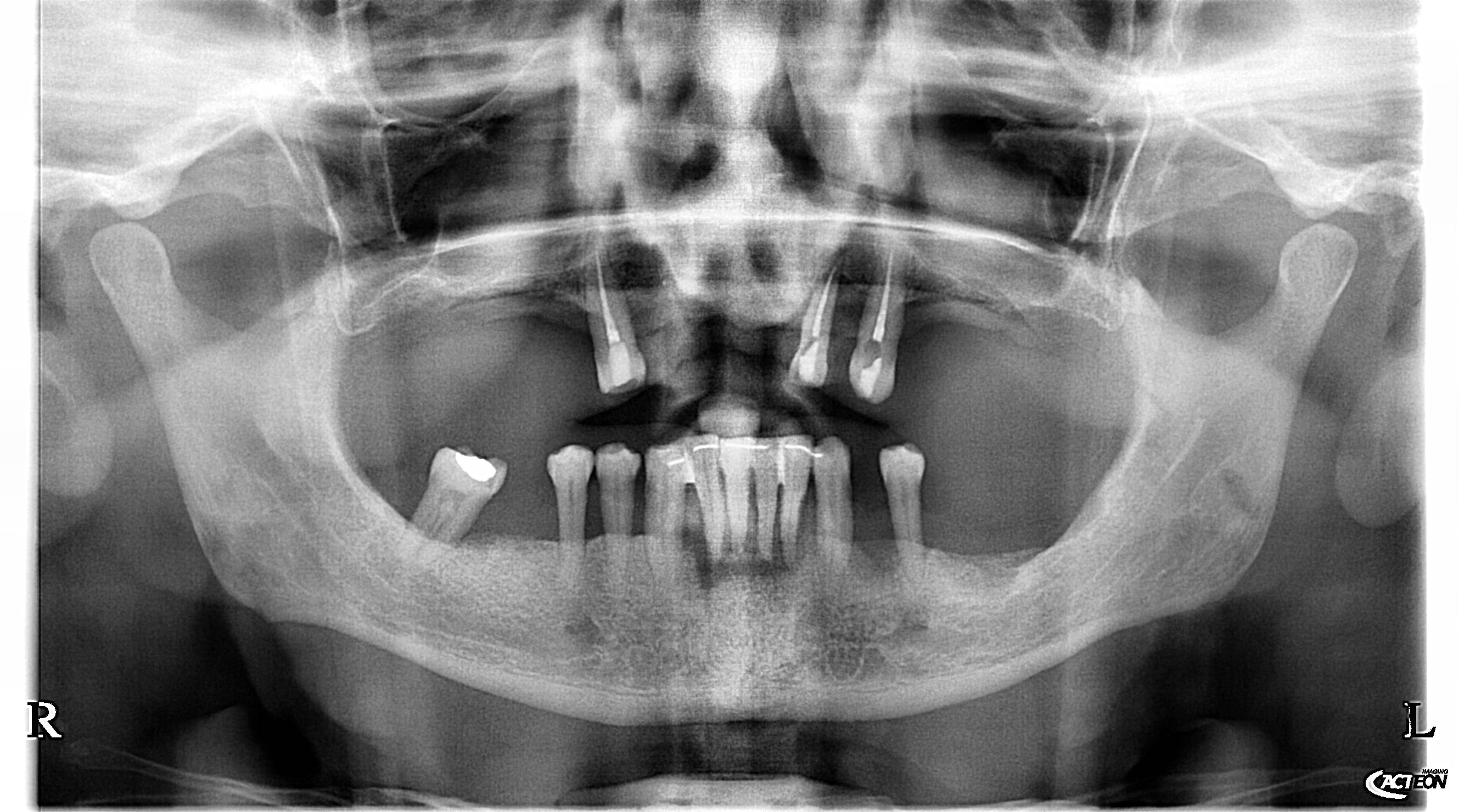 Panoramica dentale prima della riabilitazione implantare