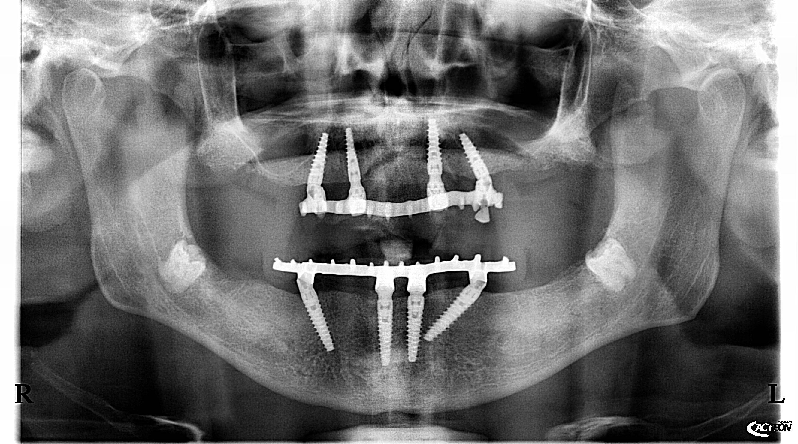 Radiografia panoramica dopo — Caso 2