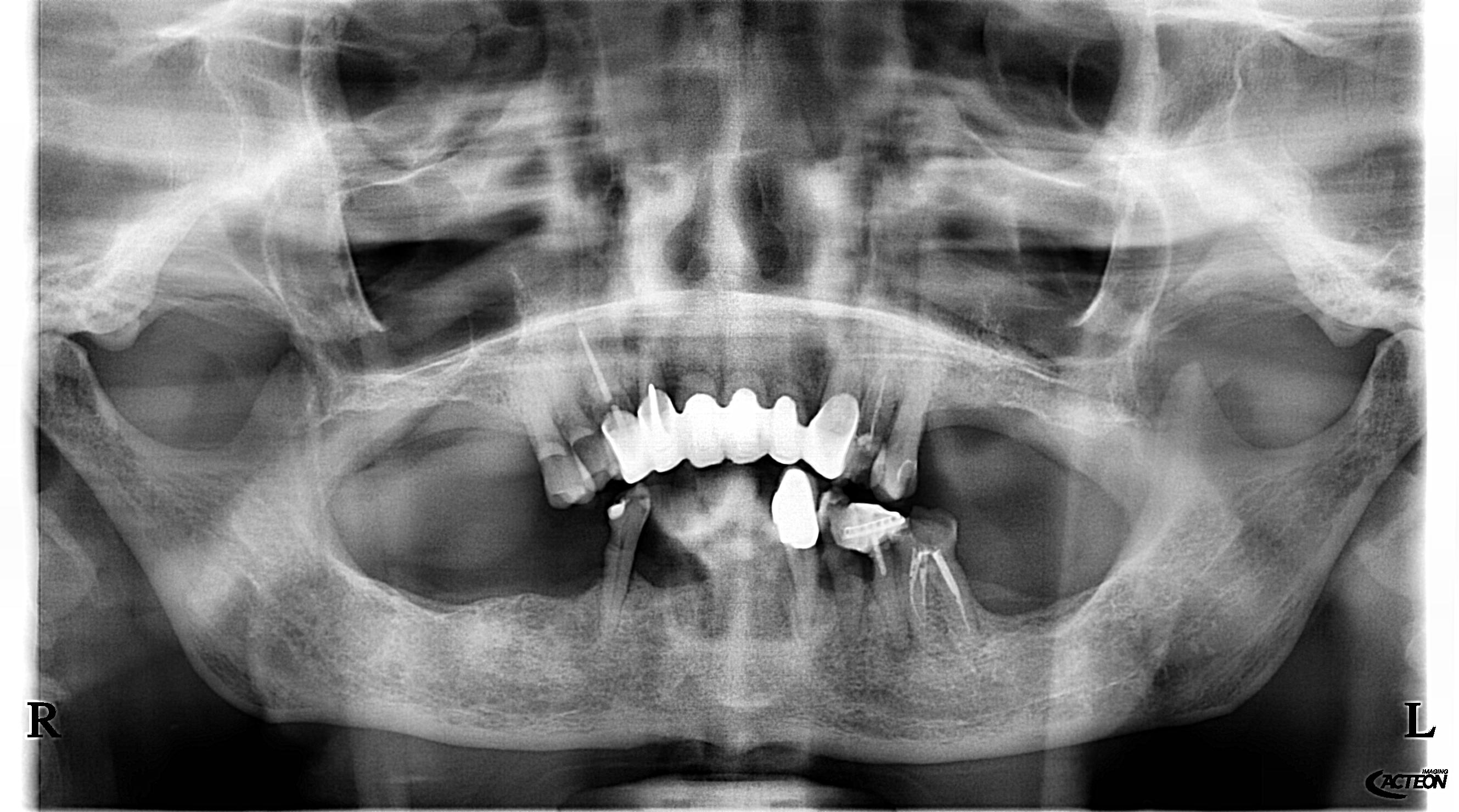 Radiografia panoramica prima — Caso 4 riabilitazione totale
