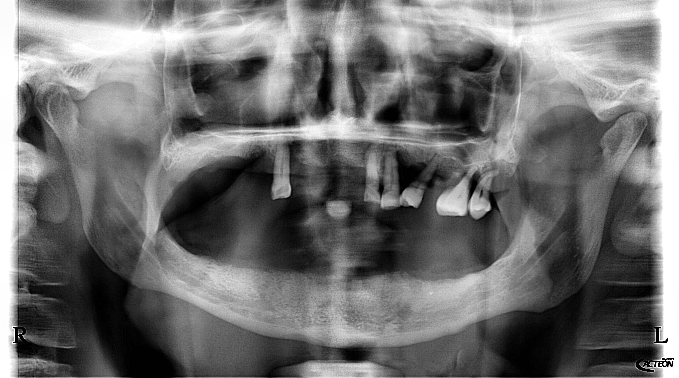 Radiografia panoramica prima — Caso 3 riabilitazione bimascellare