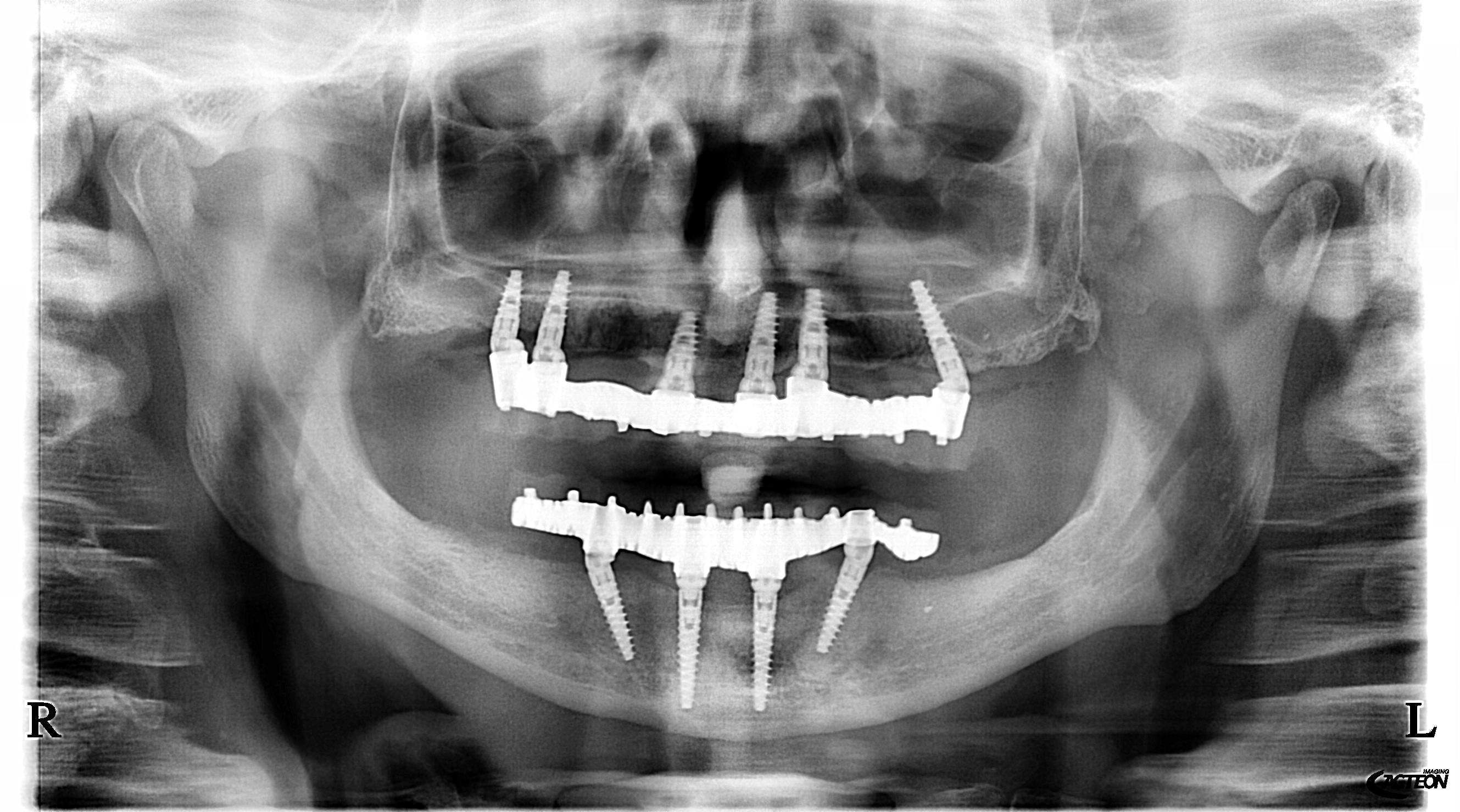Radiografia panoramica dopo — Caso 3 riabilitazione bimascellare con impianti e protesi fissa a carico immediato