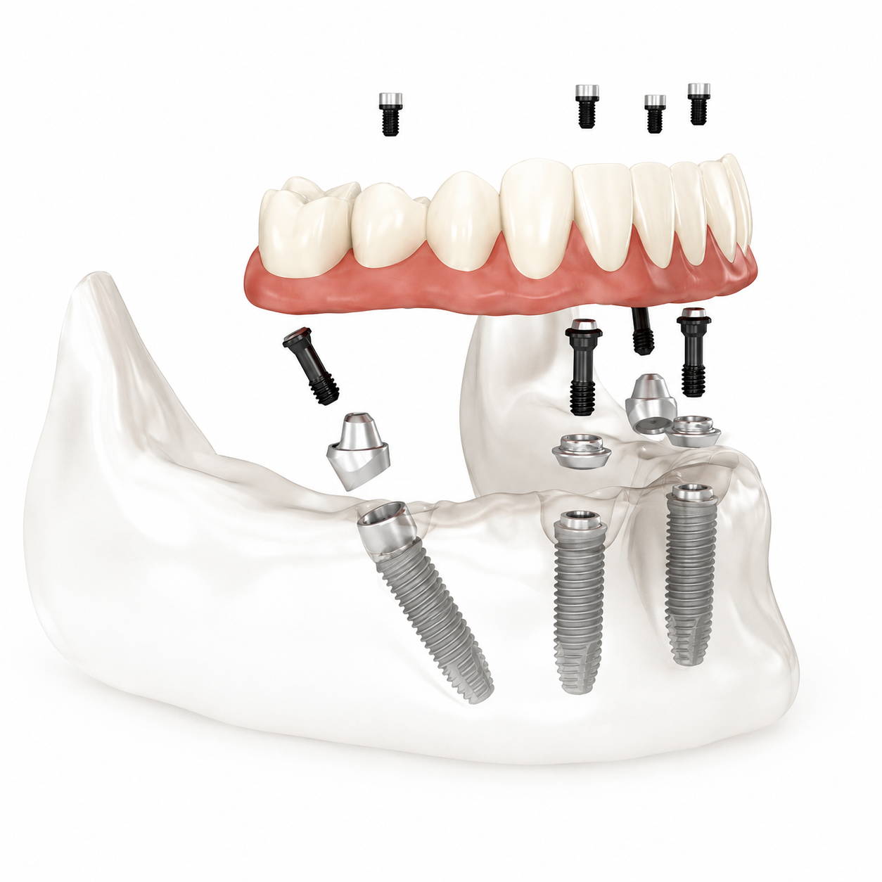 Schema di protesi fissa su impianti dentali