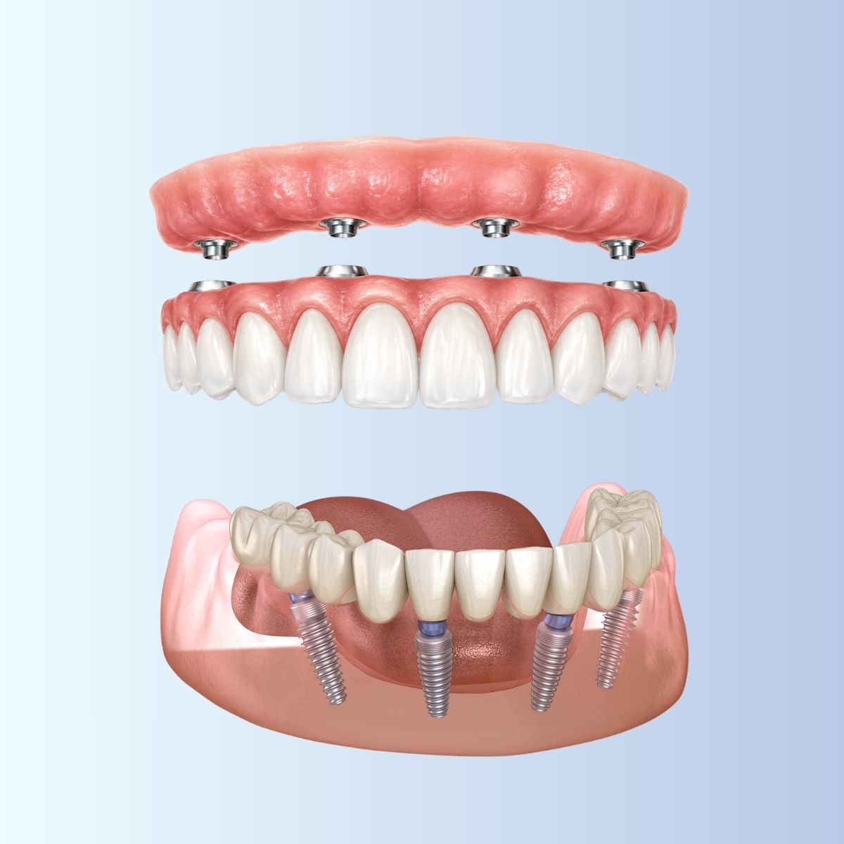 Schema di protesi fissa su impianti dentali per riabilitazione completa delle arcate