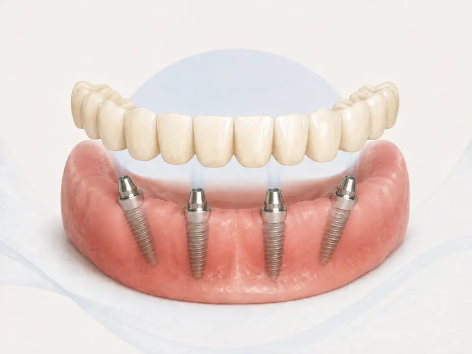 Schema di carico immediato: impianti dentali con protesi fissa applicata nella stessa giornata
