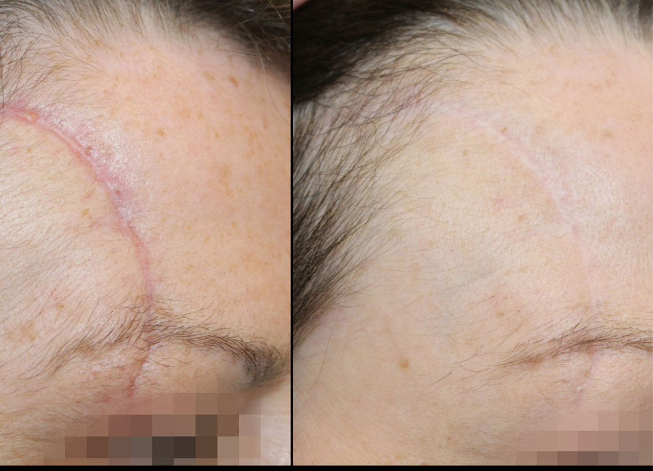 Before and after treatment example showing the appearance of a linear facial scar